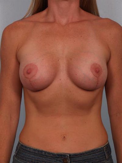 Breast Lift Before & After Gallery - Patient 1310669 - Image 2