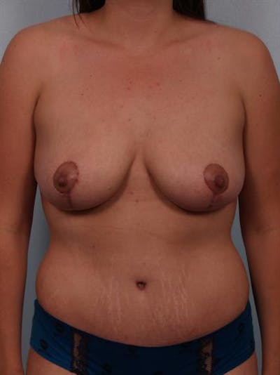 Breast Reduction Before & After Gallery - Patient 1310671 - Image 2