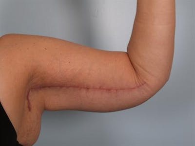 Brachioplasty (Arm Lift) Before & After Gallery - Patient 1310666 - Image 4
