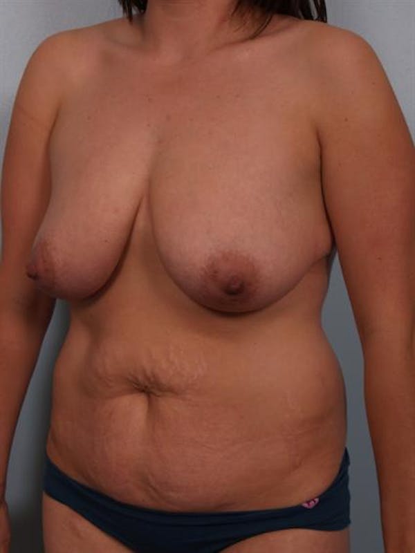 Breast Reduction Before & After Gallery - Patient 1310671 - Image 3