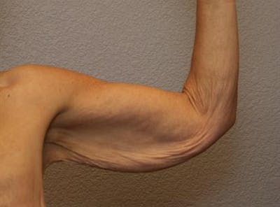 Arm