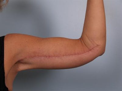 Arm with Inner Scar