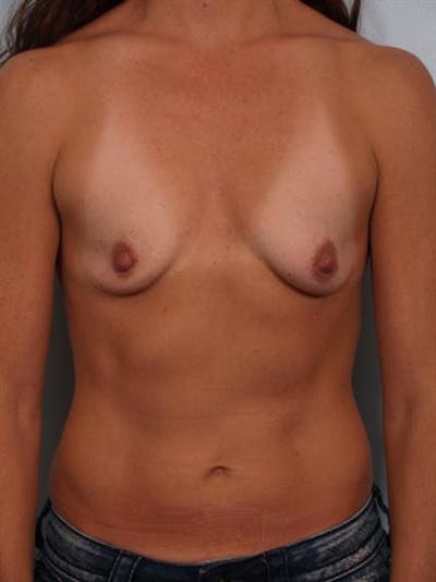 Breast Augmentation Before & After Gallery - Patient 1310677 - Image 1