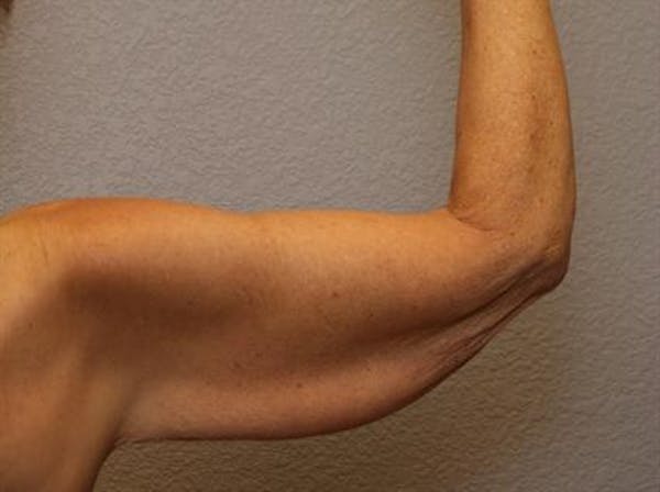 Brachioplasty (Arm Lift) Before & After Gallery - Patient 1310672 - Image 3