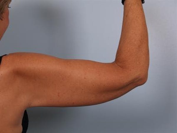 Brachioplasty (Arm Lift) Before & After Gallery - Patient 1310672 - Image 4