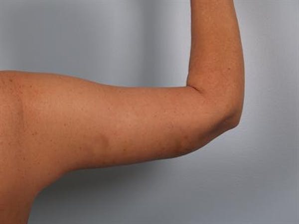 Brachioplasty (Arm Lift) Before & After Gallery - Patient 1310675 - Image 2