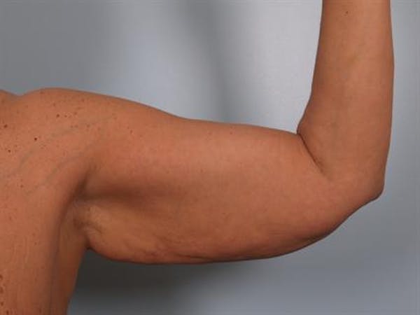 Brachioplasty (Arm Lift) Before & After Gallery - Patient 1310675 - Image 3