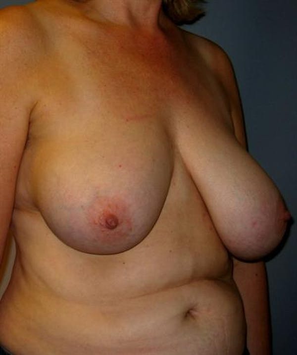 Breast Reduction Before & After Gallery - Patient 1310678 - Image 3