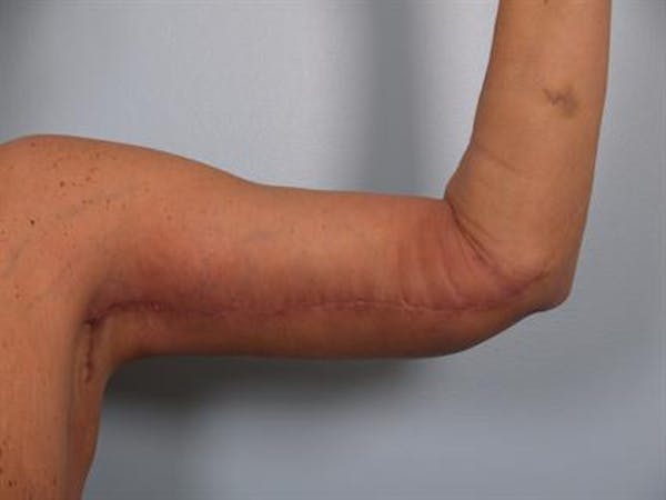 Brachioplasty (Arm Lift) Before & After Gallery - Patient 1310675 - Image 4