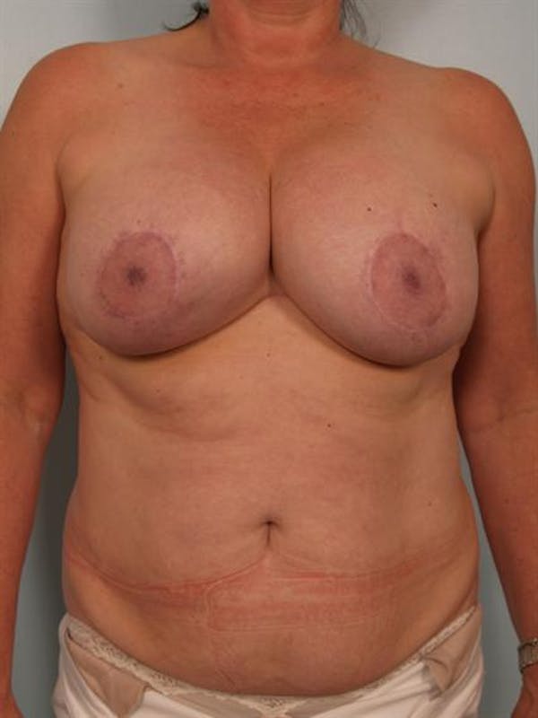 Complex Breast Revision Before & After Gallery - Patient 1310679 - Image 1