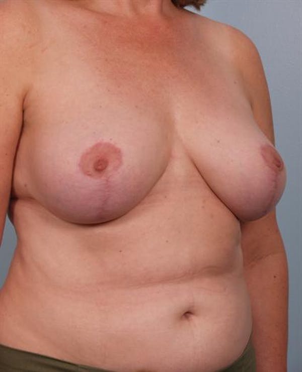 Breast Reduction Before & After Gallery - Patient 1310678 - Image 4
