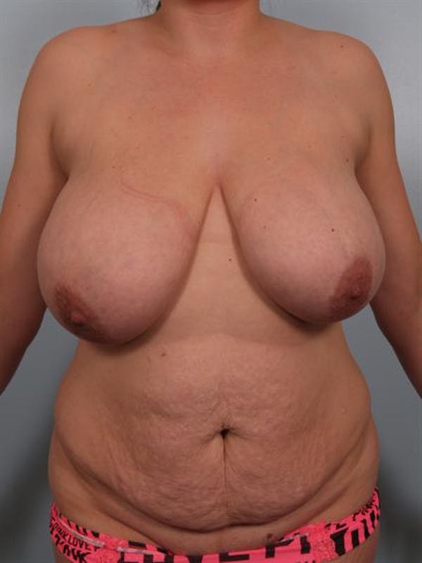 Mommy Makeover Before & After Gallery - Patient 1310680 - Image 1