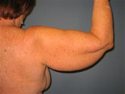 Brachioplasty (Arm Lift) Before & After Gallery - Patient 1310682 - Image 1