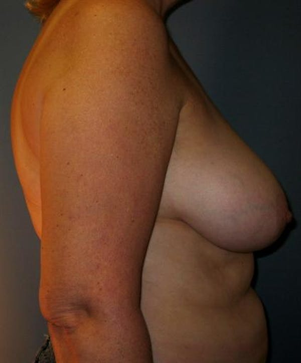 Breast Reduction Before & After Gallery - Patient 1310678 - Image 5