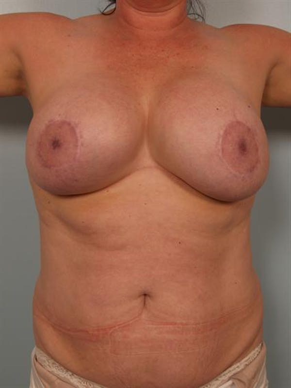 Complex Breast Revision Gallery - Patient 1310679 - Image 5
