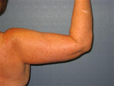 Brachioplasty (Arm Lift) Before & After Gallery - Patient 1310682 - Image 2