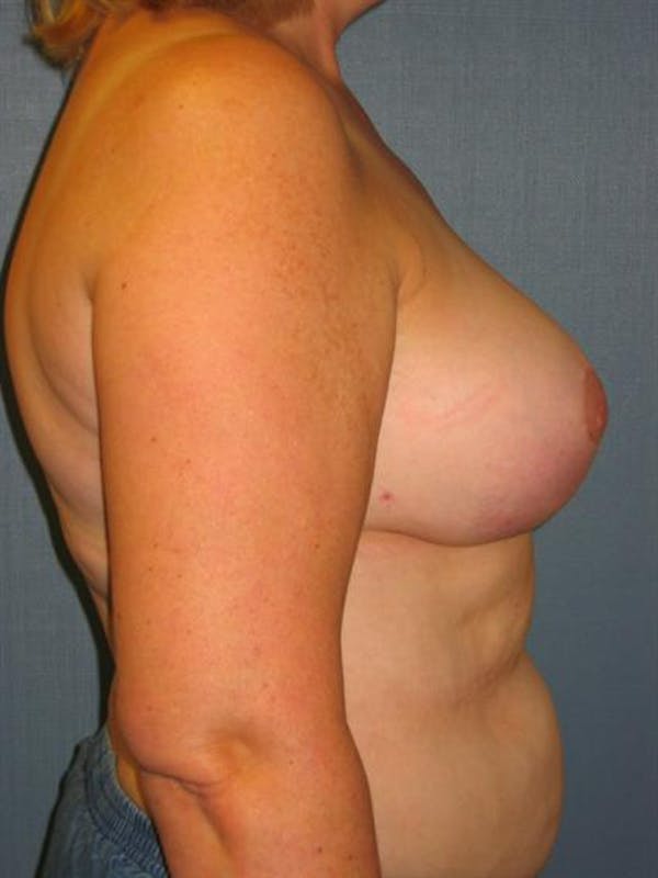 Breast Reduction Before & After Gallery - Patient 1310678 - Image 6