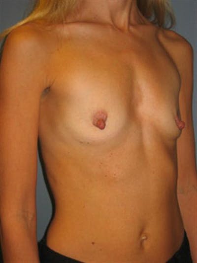 Breast Augmentation Before & After Gallery - Patient 1310688 - Image 1