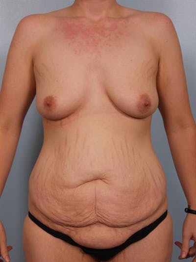 Breast Lift Before & After Gallery - Patient 1310683 - Image 1