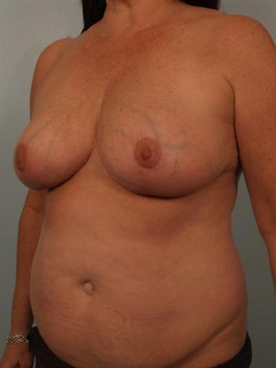 Breast Reduction Before & After Gallery - Patient 1310684 - Image 4