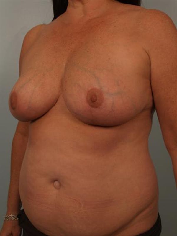 Breast Reduction Before & After Gallery - Patient 1310684 - Image 4