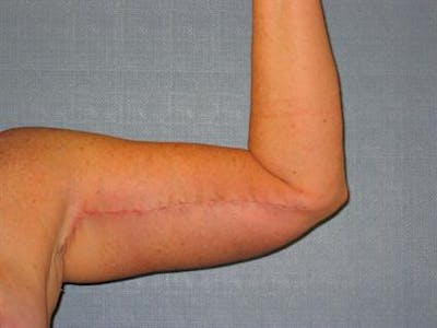Brachioplasty (Arm Lift) Before & After Gallery - Patient 1310682 - Image 6