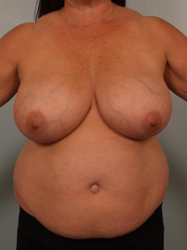 Breast Reduction Before & After Gallery - Patient 1310684 - Image 1