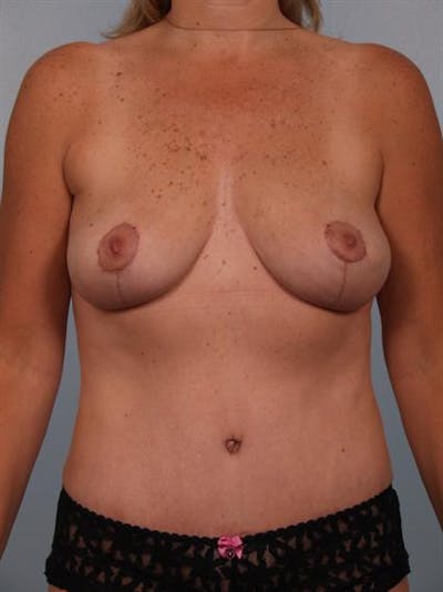 Mommy Makeover Before & After Gallery - Patient 1310686 - Image 2