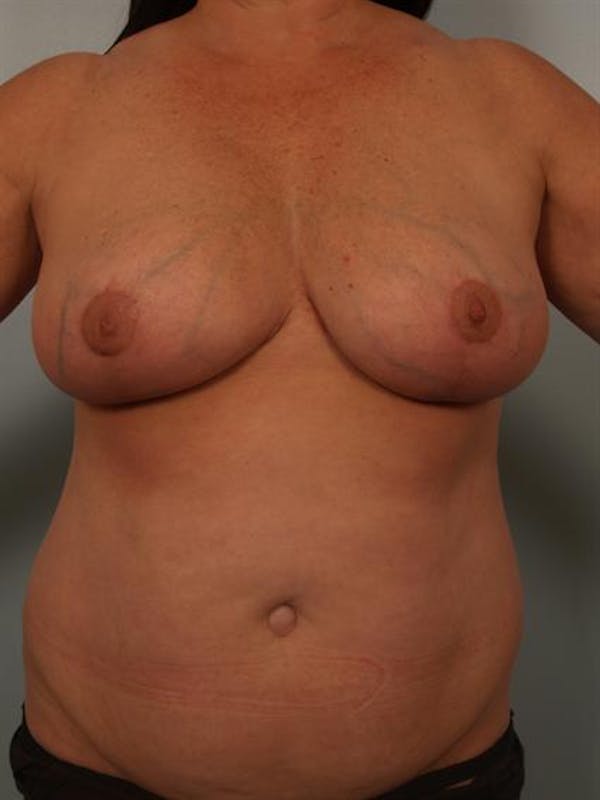 Breast Reduction Before & After Gallery - Patient 1310684 - Image 2