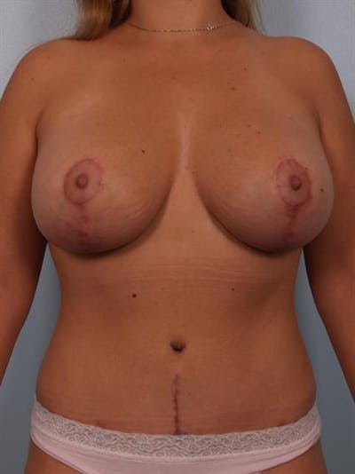 Complex Breast Revision Before & After Gallery - Patient 1310685 - Image 2