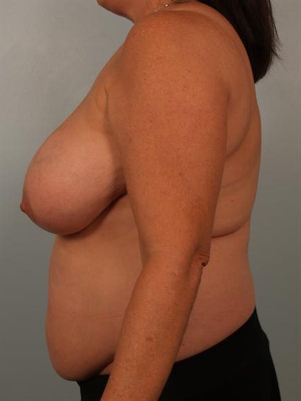Breast Reduction Before & After Gallery - Patient 1310684 - Image 5