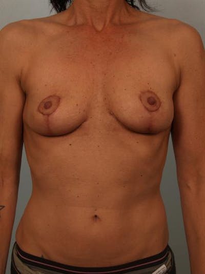 Breast Lift Gallery - Patient 1310689 - Image 2