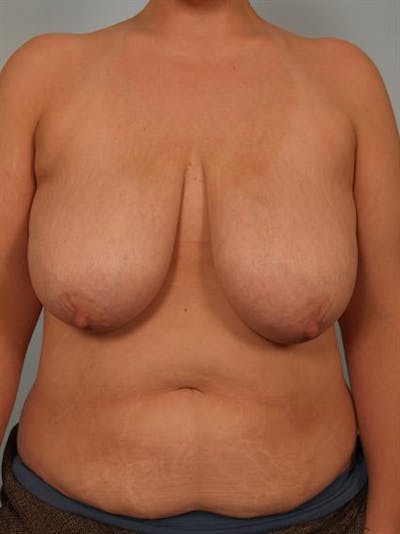 Breast Reduction Before & After Gallery - Patient 1310691 - Image 1