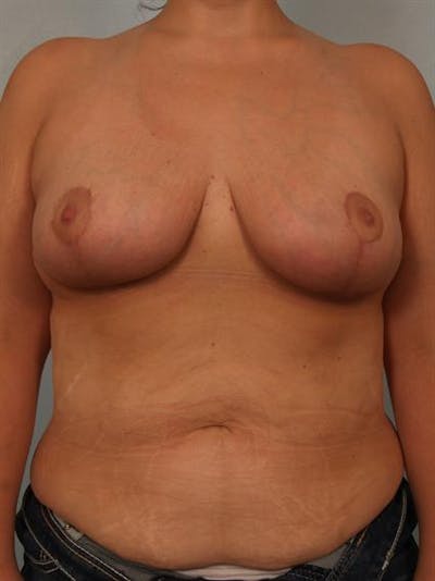 Breast Reduction Before & After Gallery - Patient 1310691 - Image 2