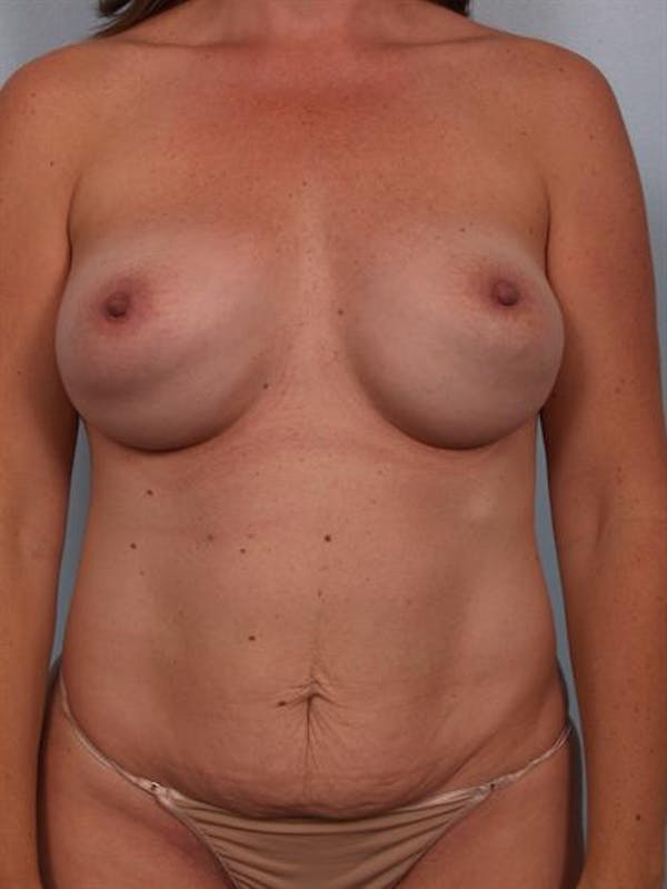 Power Assisted Liposuction Before & After Gallery - Patient 1310692 - Image 1