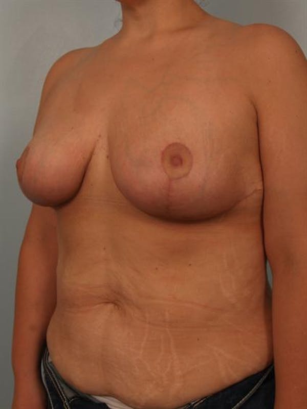 Breast Reduction Before & After Gallery - Patient 1310691 - Image 4
