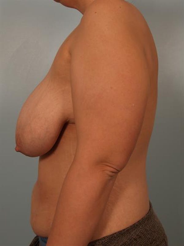Breast Reduction Before & After Gallery - Patient 1310691 - Image 5