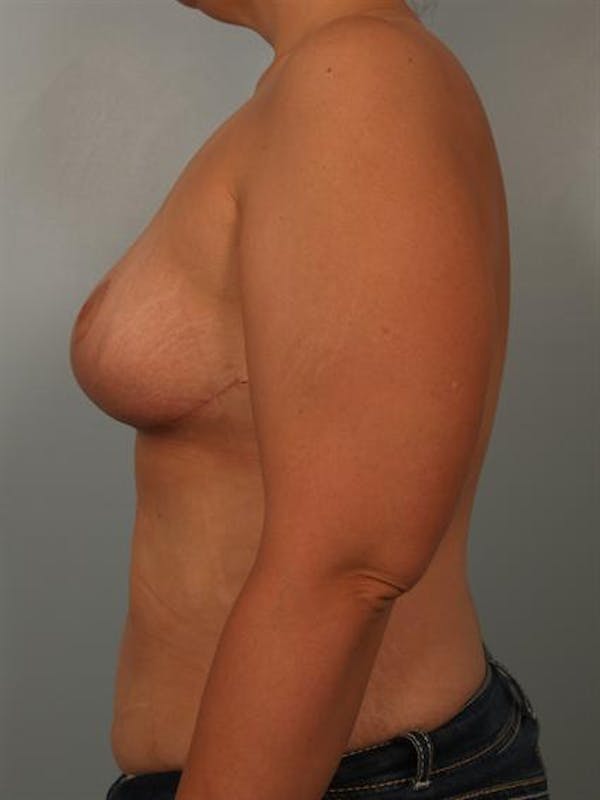 Breast Reduction Gallery - Patient 1310691 - Image 6