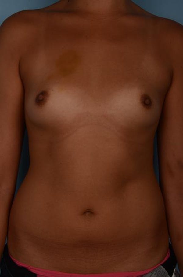 Breast Augmentation Before & After Gallery - Patient 1310696 - Image 3