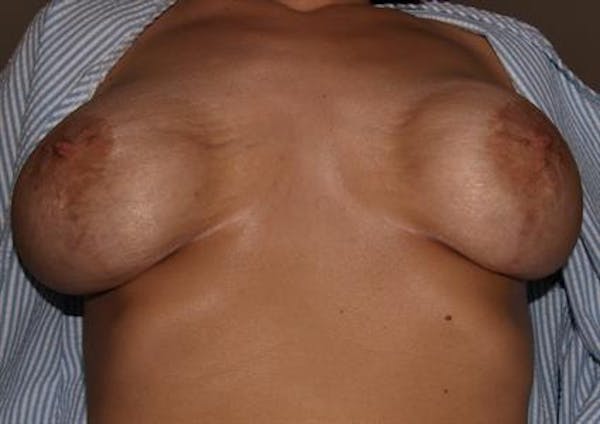 Complex Breast Revision Before & After Gallery - Patient 1310695 - Image 7