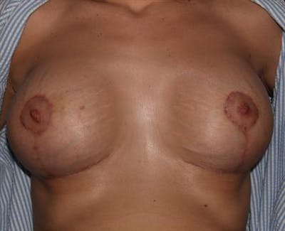 Complex Breast Revision Before & After Gallery - Patient 1310695 - Image 8