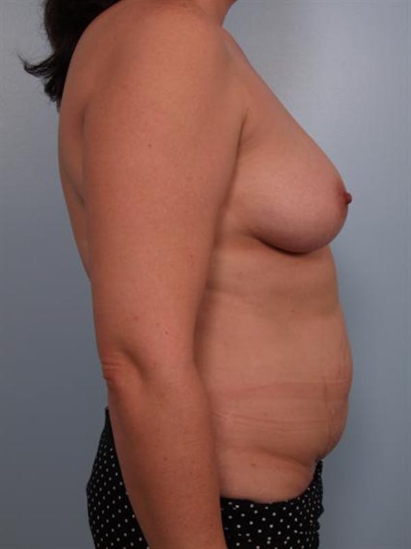 Mommy Makeover Before & After Gallery - Patient 1310699 - Image 3