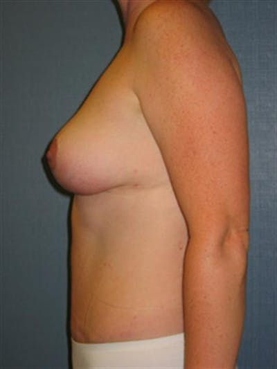 Breast Reduction Before & After Gallery - Patient 1310697 - Image 4