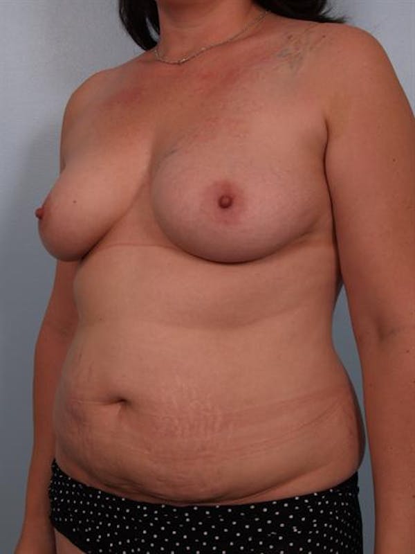 Mommy Makeover Before & After Gallery - Patient 1310699 - Image 5