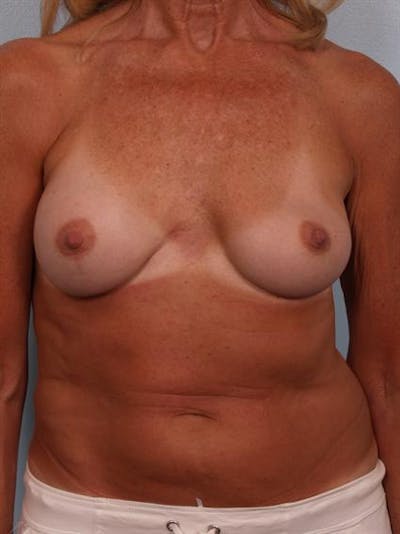Complex Breast Revision Before & After Gallery - Patient 1310701 - Image 1