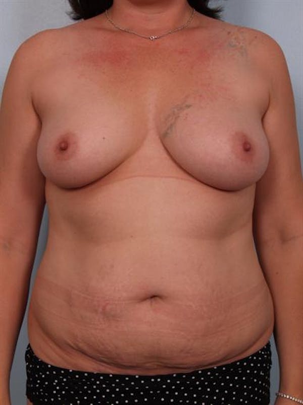 Mommy Makeover Before & After Gallery - Patient 1310699 - Image 1