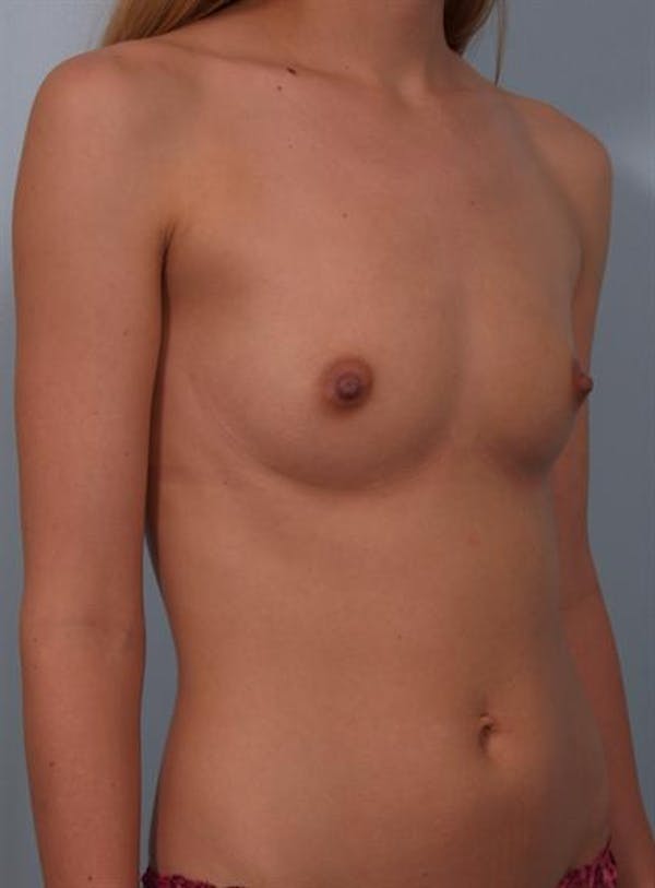 Breast Augmentation Before & After Gallery - Patient 1310702 - Image 1