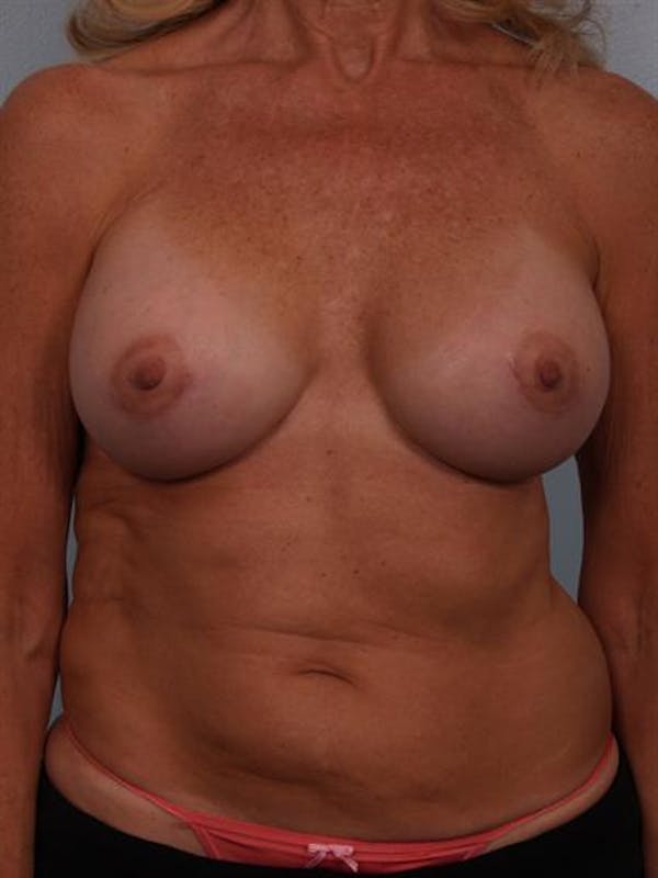 Complex Breast Revision Before & After Gallery - Patient 1310701 - Image 2