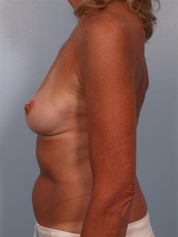 Complex Breast Revision Before & After Gallery - Patient 1310701 - Image 3