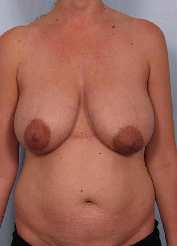 Breast Reduction Before & After Gallery - Patient 1310703 - Image 1